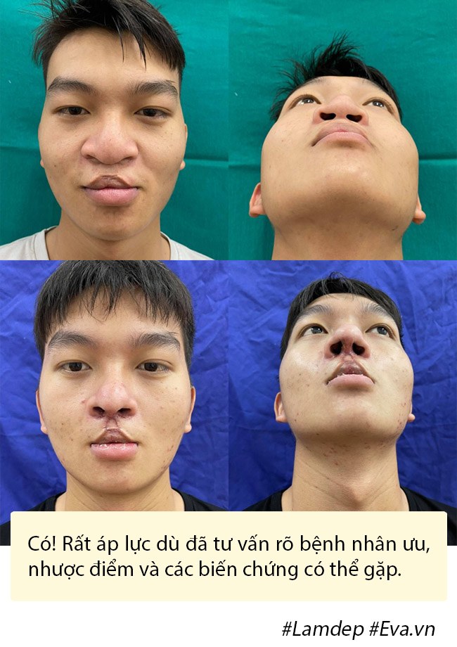 Dao k&eacute;o hỏng: Nỗi khổ của bệnh nh&acirc;n v&agrave; c&aacute;i kh&oacute; của b&aacute;c sĩ - Ảnh 13.