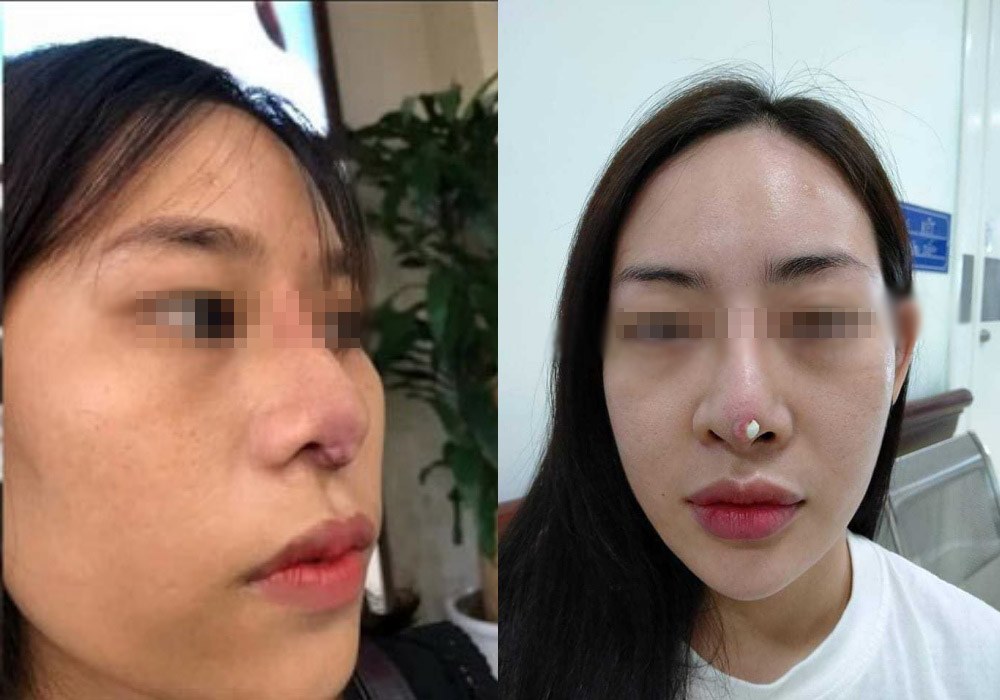Dao k&eacute;o hỏng: Nỗi khổ của bệnh nh&acirc;n v&agrave; c&aacute;i kh&oacute; của b&aacute;c sĩ - Ảnh 3.