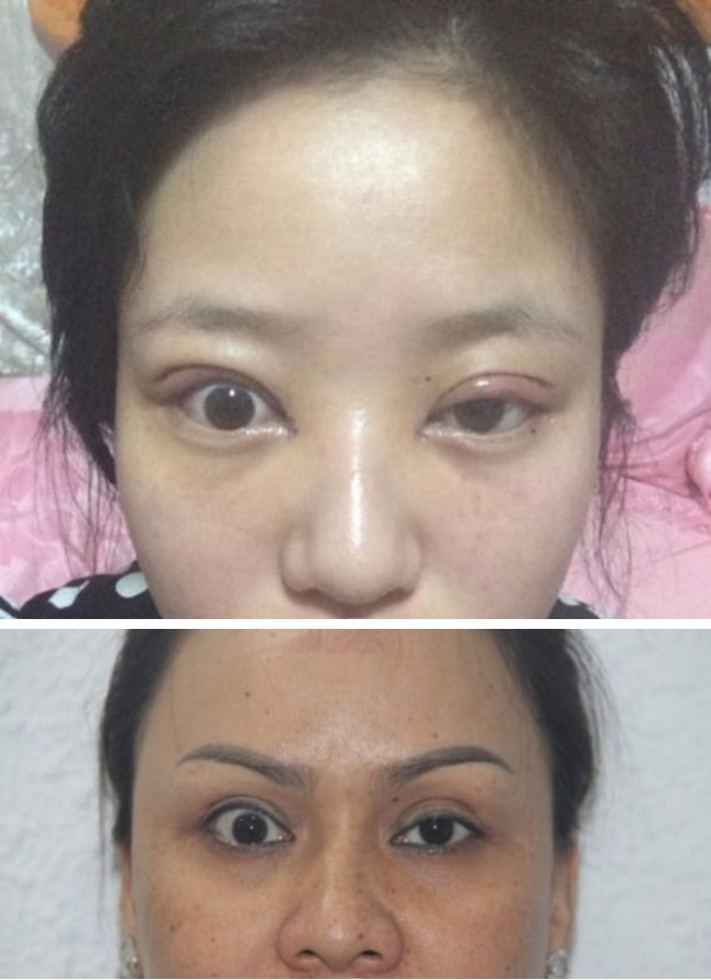 Dao k&eacute;o hỏng: Nỗi khổ của bệnh nh&acirc;n v&agrave; c&aacute;i kh&oacute; của b&aacute;c sĩ - Ảnh 5.