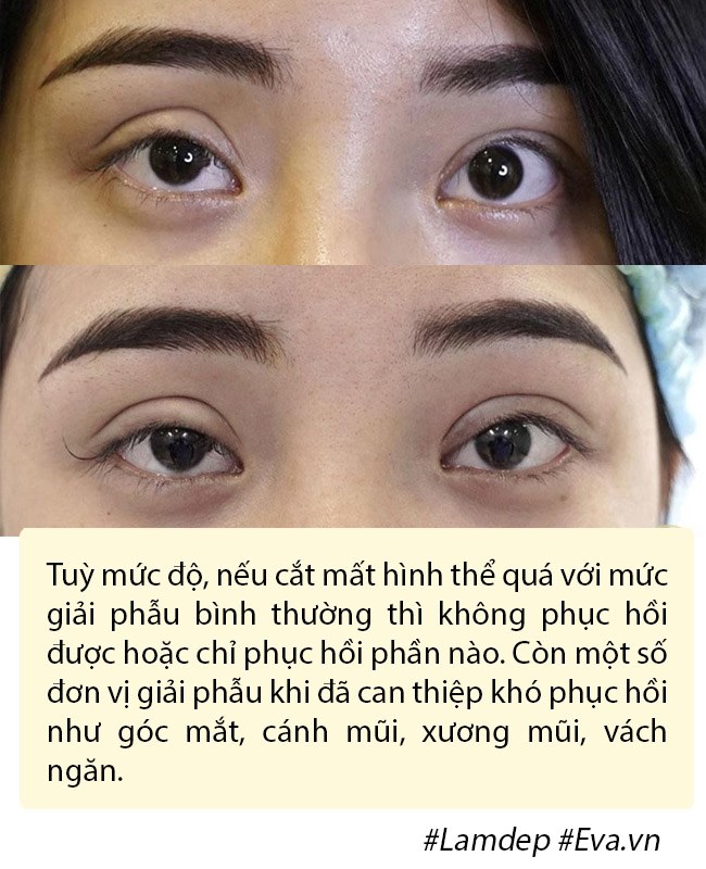Dao k&eacute;o hỏng: Nỗi khổ của bệnh nh&acirc;n v&agrave; c&aacute;i kh&oacute; của b&aacute;c sĩ - Ảnh 9.