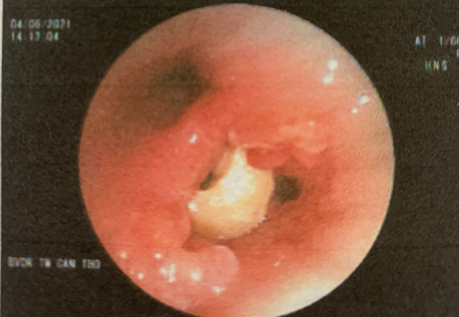 Ăn gói xôi, cụ ông 95 tuổi bị hạt đậu phộng lọt vào phổi 2 tháng