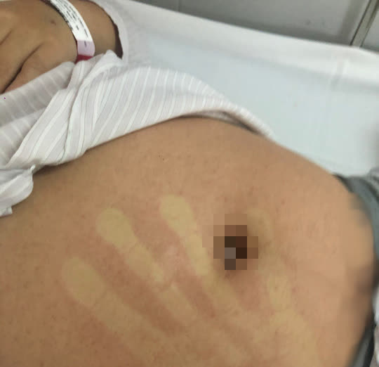 Sốt cao sau ti&ecirc;m vắc-xin Covid-19, tưởng phản ứng ai ngờ sốt xuất huyết - Ảnh 2.