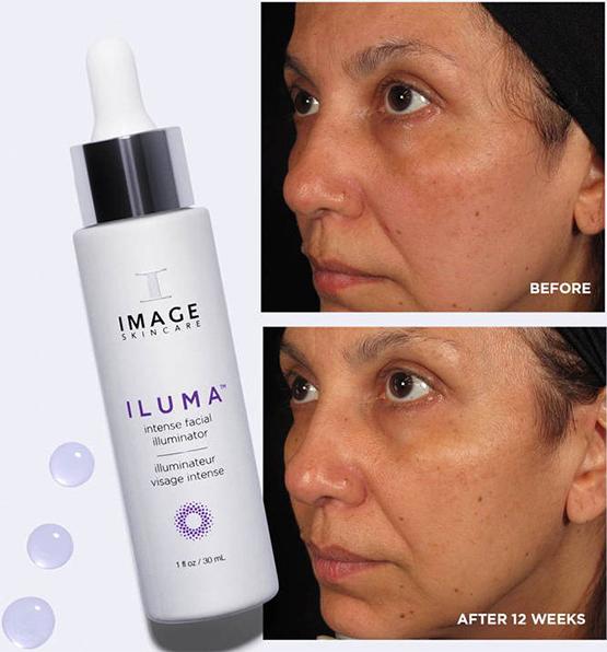 Hướng dẫn sử dụng serum trị nám Image Iluma Intense Facial Illuminator đạt hiệu quả trị nám tận gốc - Ảnh 2.