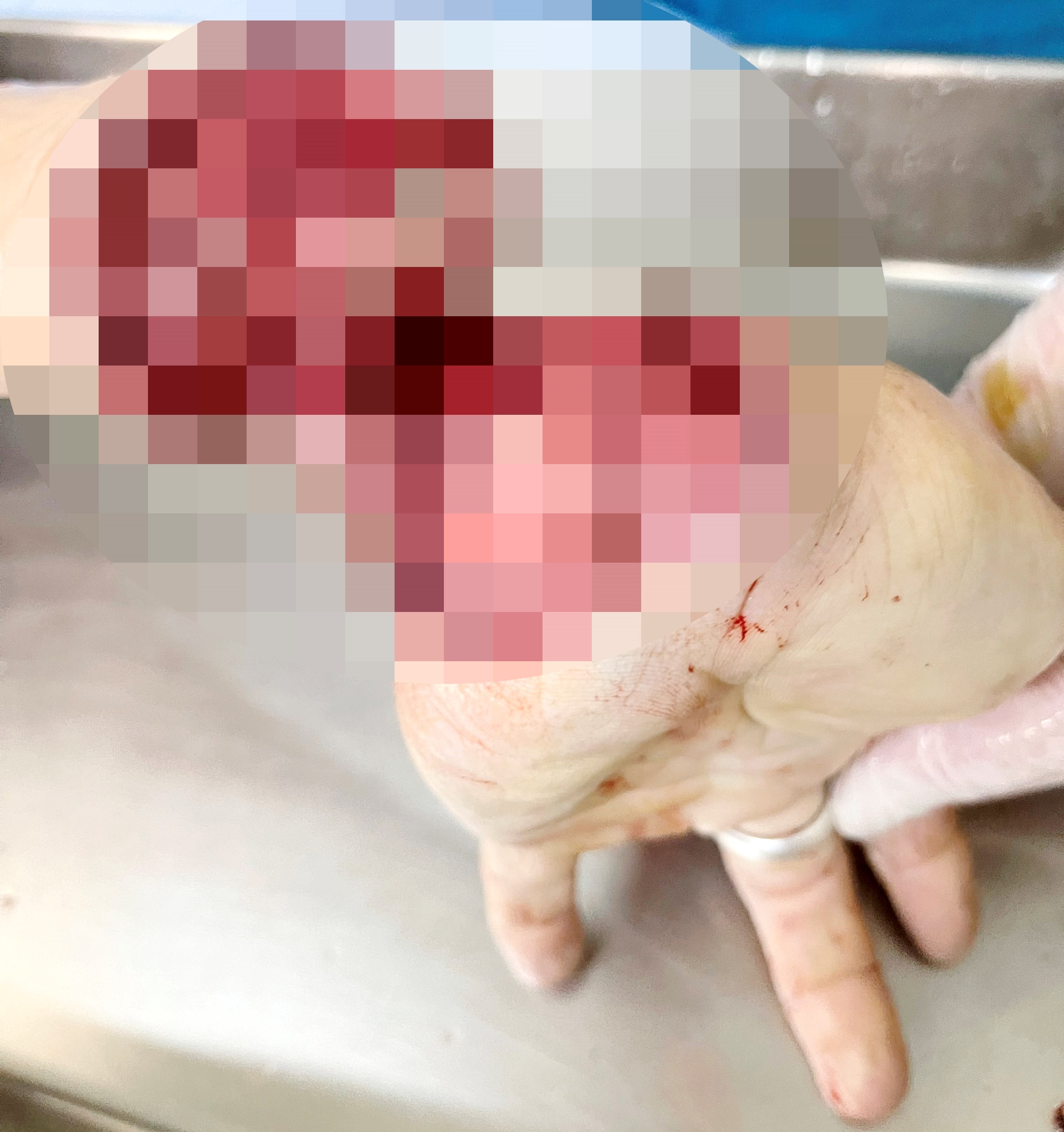Nối th&agrave;nh c&ocirc;ng b&agrave;n tay người đ&agrave;n &ocirc;ng bị đứt l&igrave;a do tai nạn lao động - Ảnh 2.