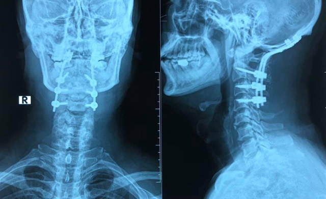 Nhảy xuống bể bơi &iacute;t nước, người đ&agrave;n &ocirc;ng g&atilde;y đốt sống cổ - Ảnh 1.