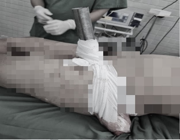 Cứu sống nam thanh niên bị ống sắt lan can đâm xuyên đùi