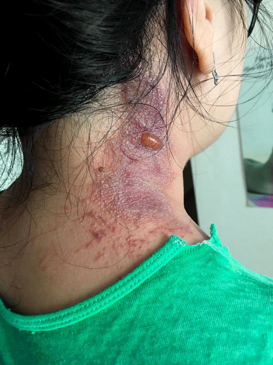 Lở loét, nhiễm thêm độc tố vì nhà thuốc chẩn đoán nhầm