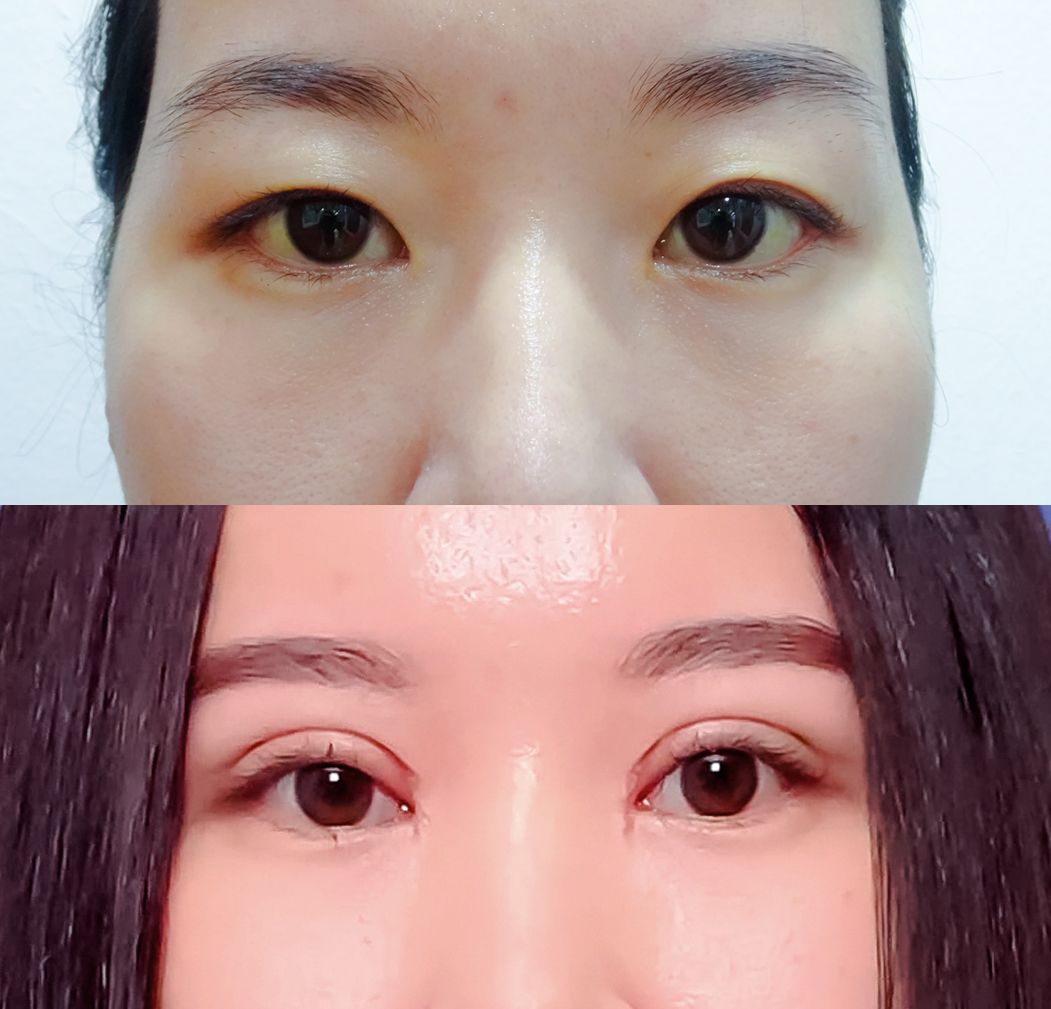 Làm đẹp đón Tết, cắt mắt hai mí ở đâu mới an toàn? - Ảnh 3.