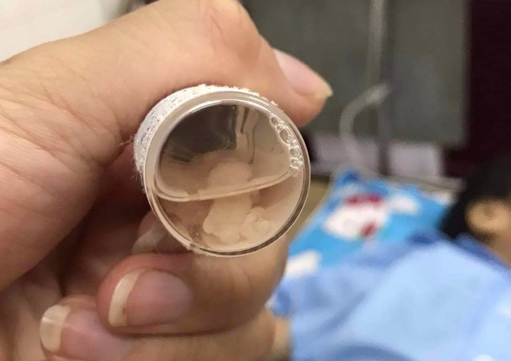 Bé gái 3 tuổi bị người tình của mẹ găm đinh vào đầu rất nguy kịch