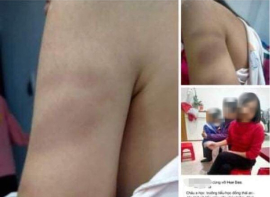 Cô giáo đánh tím tay học sinh lớp 1
