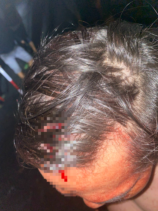 Côn đồ chém trọng thương 5 bảo vệ tại dự án điện gió