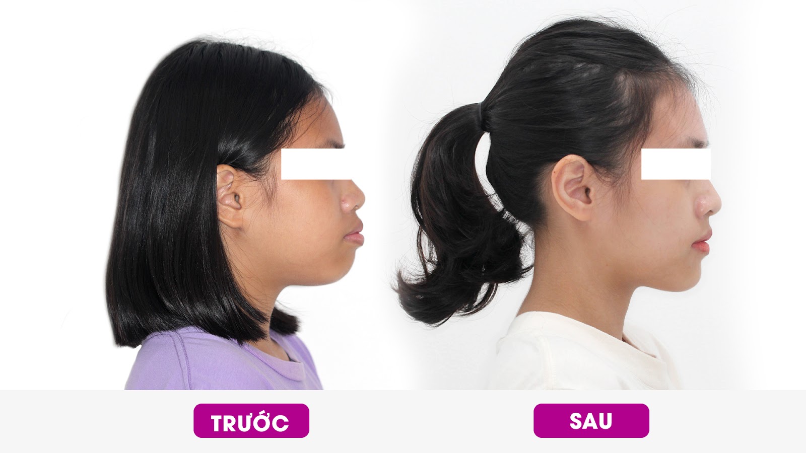Chỉnh nha để c&acirc;n đối tỉ lệ v&agrave;ng mũi - m&ocirc;i - cằm - Ảnh 1.