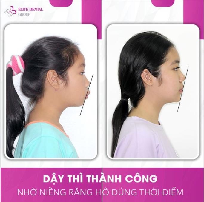 Chỉnh nha để c&acirc;n đối tỉ lệ v&agrave;ng mũi - m&ocirc;i - cằm - Ảnh 2.