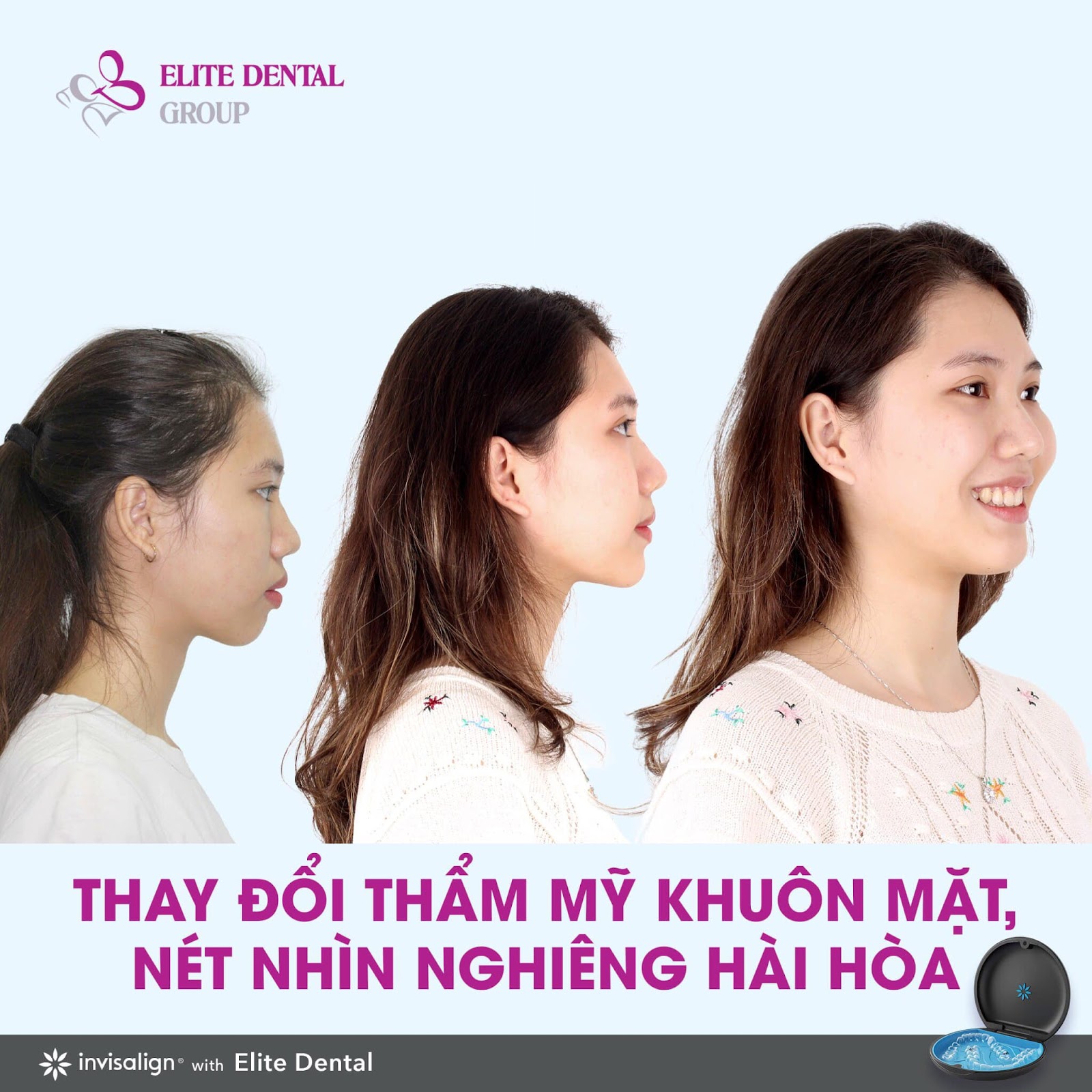 Chỉnh nha để c&acirc;n đối tỉ lệ v&agrave;ng mũi - m&ocirc;i - cằm - Ảnh 3.