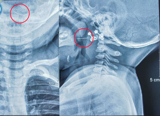 Gắp sợi th&eacute;p đ&acirc;m xuy&ecirc;n Amidan b&eacute; 13 th&aacute;ng tuổi - Ảnh 1.