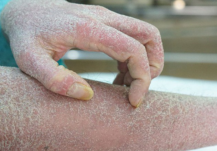 Vì sao căng thẳng, stress khiến bệnh vảy nến càng trầm trọng?