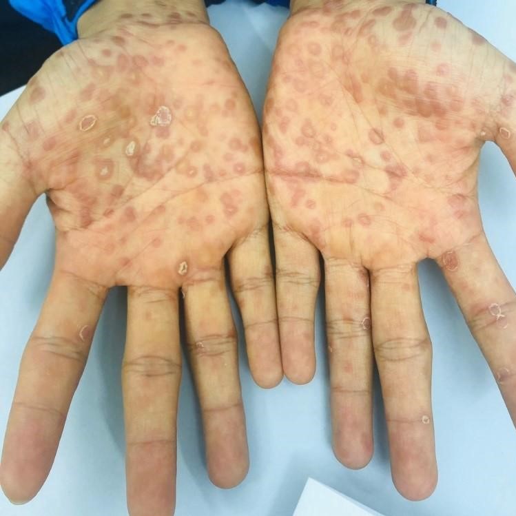 Bác sĩ Đoàn Văn Lợi Em cảnh báo nóng về giang mai