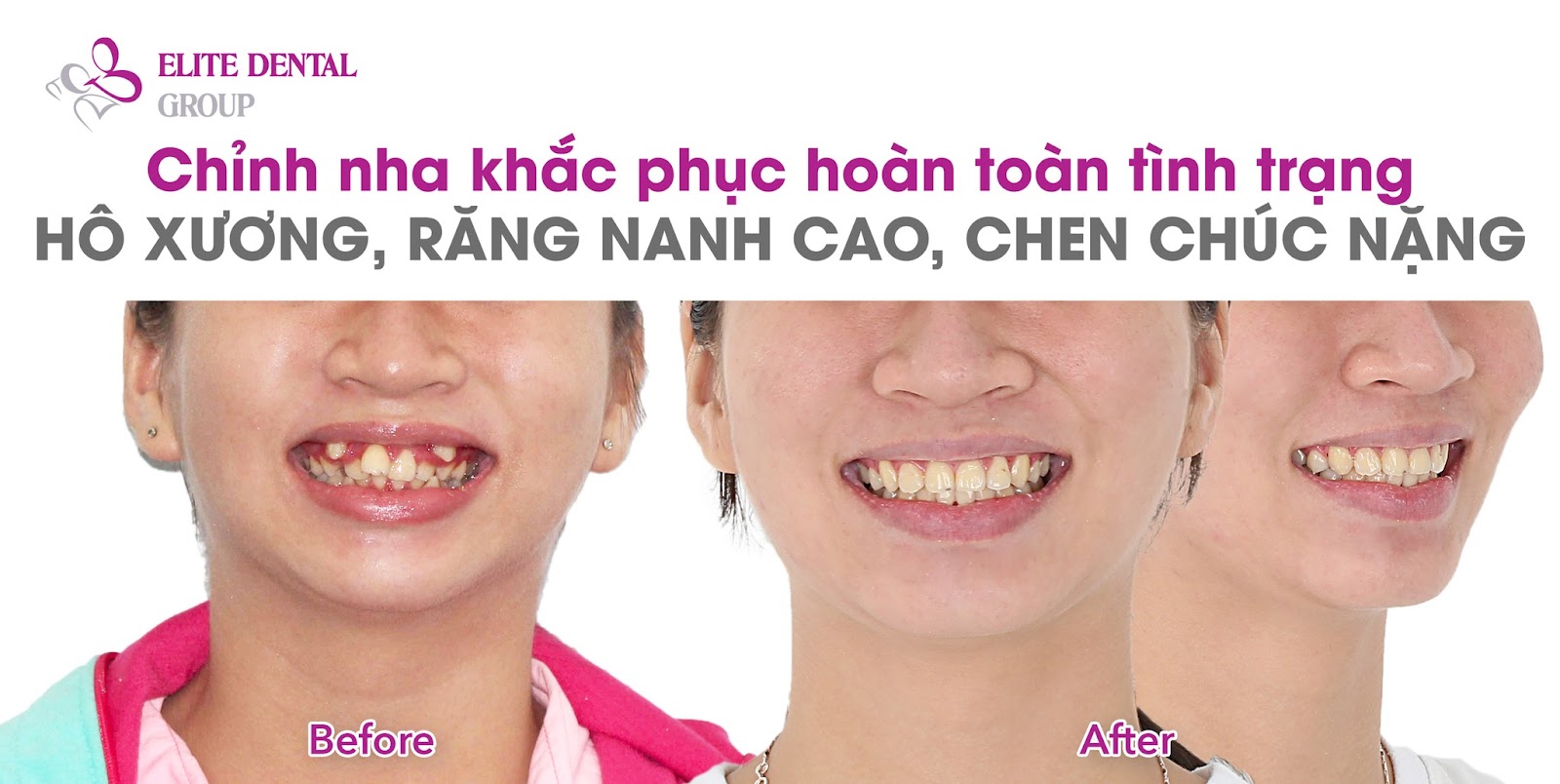 Để có một hành trình niềng răng suôn sẻ, cần lưu ý những điểm sau - Ảnh 3.