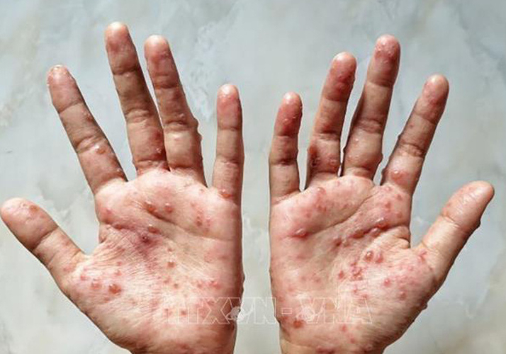 Phát hiện ca đậu mùa khỉ đầu tiên, 6 khuyến cáo phòng bệnh