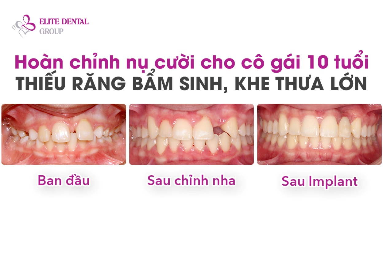 H&agrave;nh tr&igrave;nh sở hữu nụ cười khỏe đẹp to&agrave;n diện c&oacute; gian nan kh&ocirc;ng? - Ảnh 1.