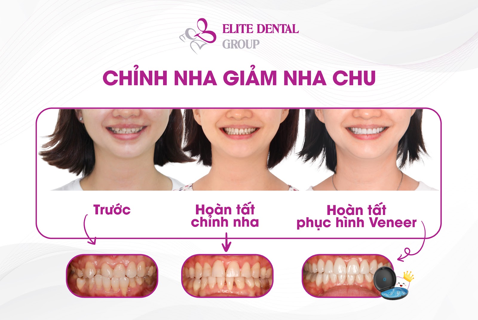 H&agrave;nh tr&igrave;nh sở hữu nụ cười khỏe đẹp to&agrave;n diện c&oacute; gian nan kh&ocirc;ng? - Ảnh 2.