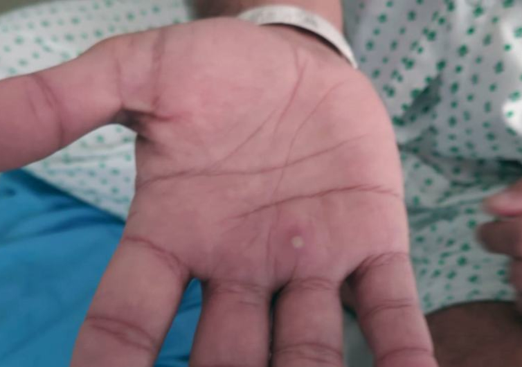 Ai có nguy cơ cao mắc bệnh đậu mùa khỉ?