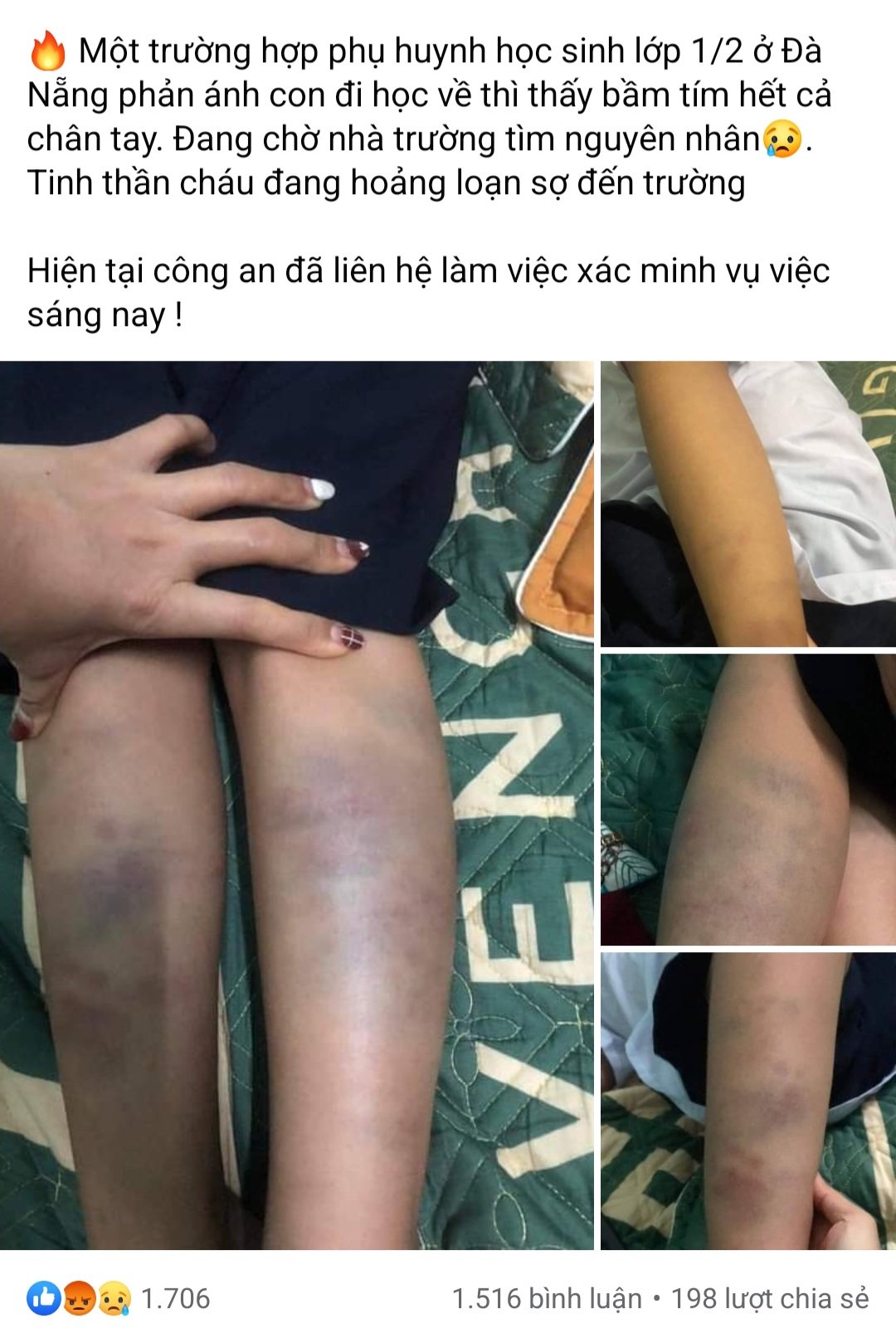 Làm rõ thông tin một học sinh lớp 1 bị bầm tím chân tay - Ảnh 2.