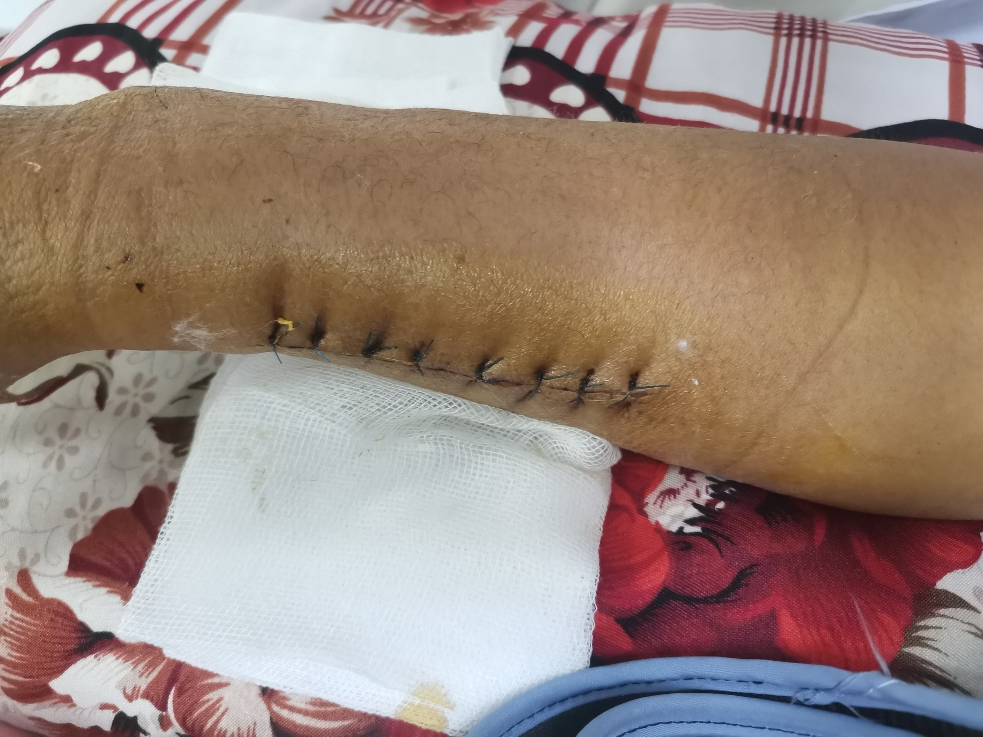 Su&yacute;t mất tay v&igrave; bị cuốn v&agrave;o m&aacute;y tiện - Ảnh 2.