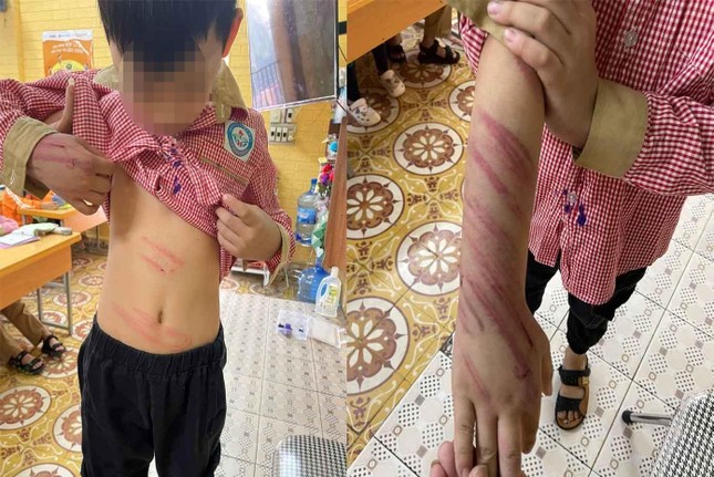 Xác minh vụ bé trai 8 tuổi bị người tình của mẹ bạo hành