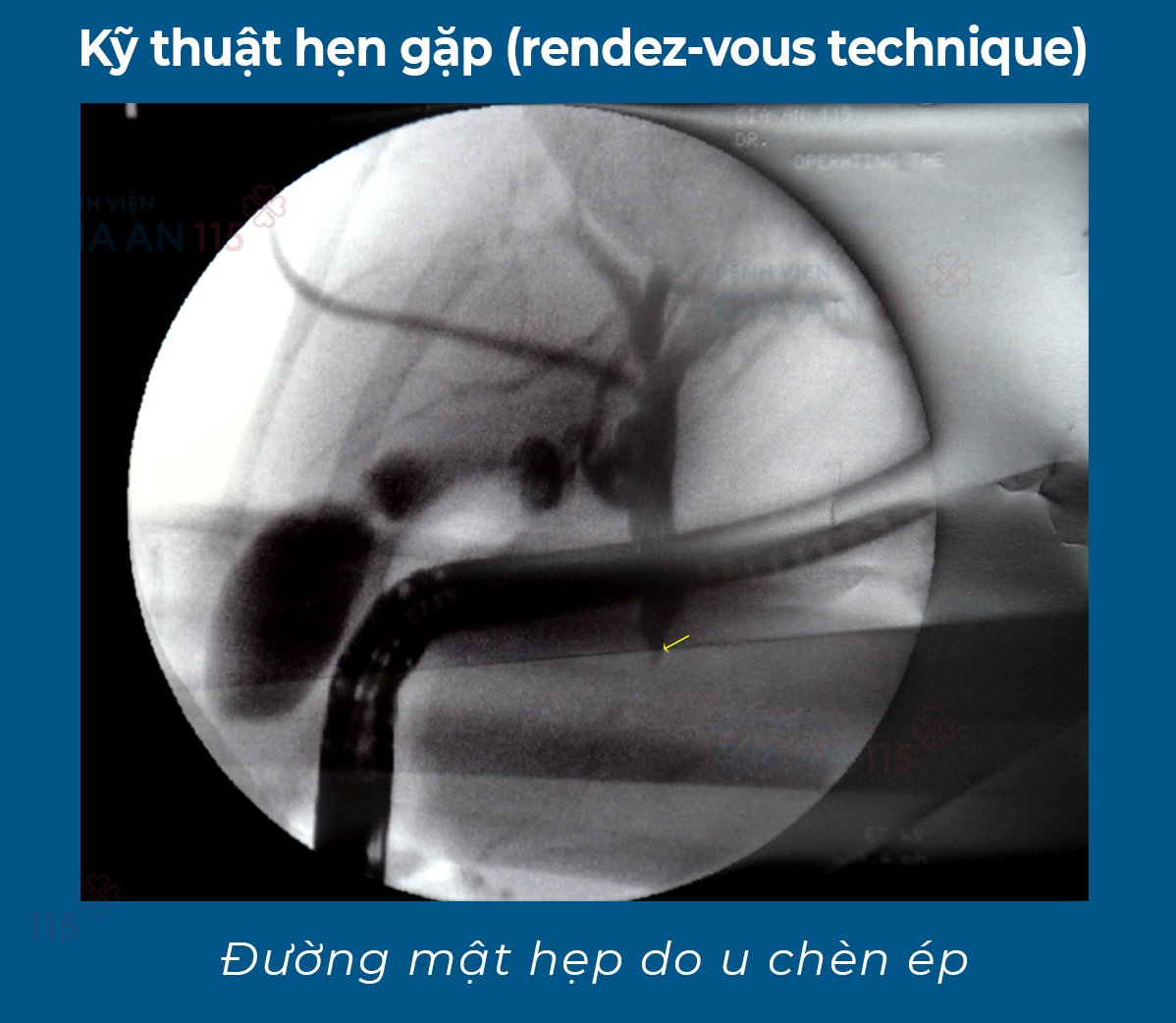 Dùng phương pháp cuối cùng cứu người phụ nữ nguy kịch