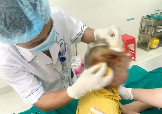 Bé 3 tuổi bị chó hàng xóm cắn trọng thương vùng đầu, mặt