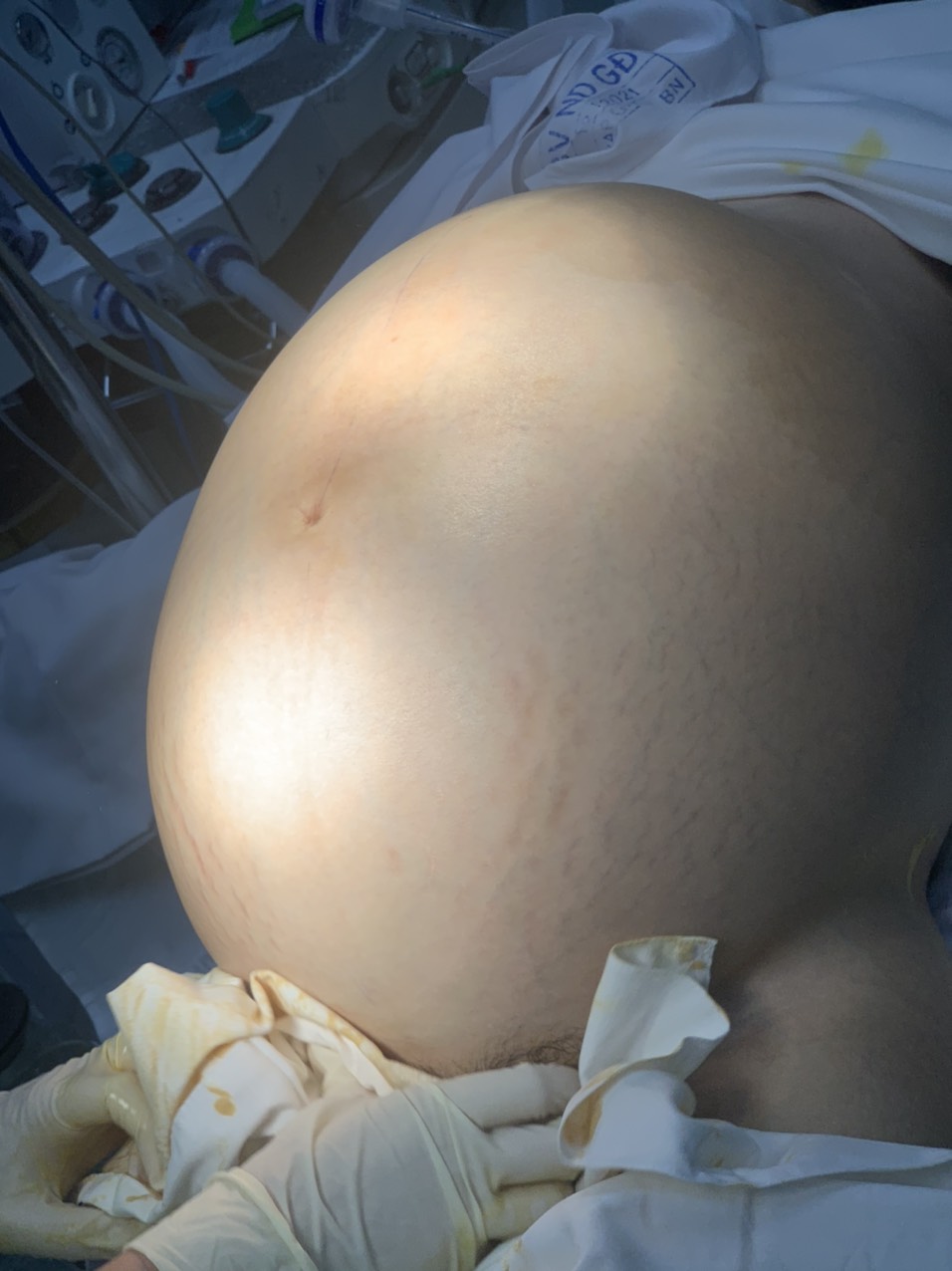 Nữ du học sinh 18 tuổi về nước để cắt bỏ khối u 22 kg ở bụng