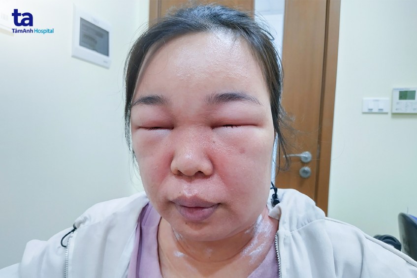 Sau thoa mỹ phẩm, người phụ nữ phải đi xe lăn