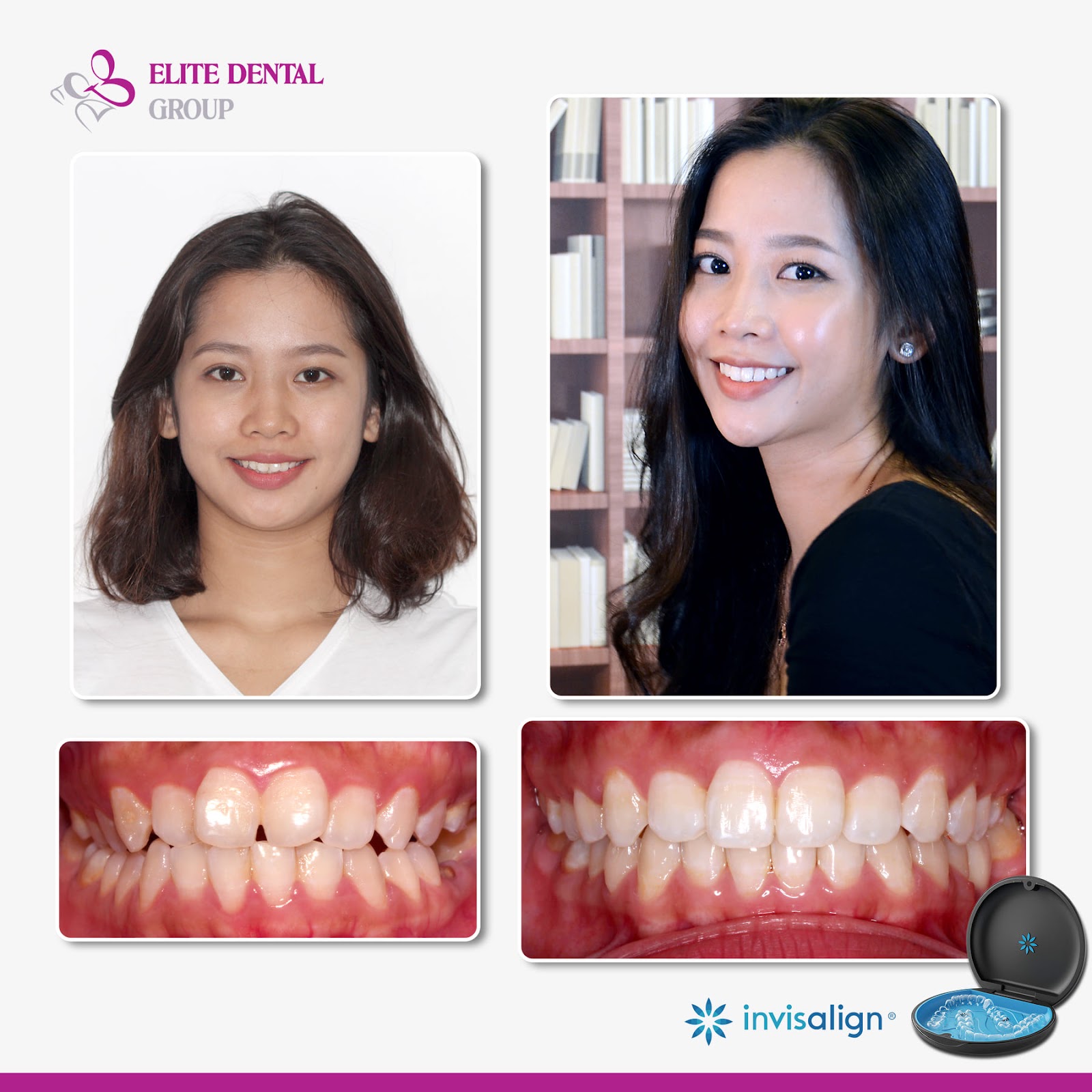 Khi n&agrave;o cần l&agrave;m th&ecirc;m điều trị thẩm mỹ sau niềng răng? - Ảnh 1.