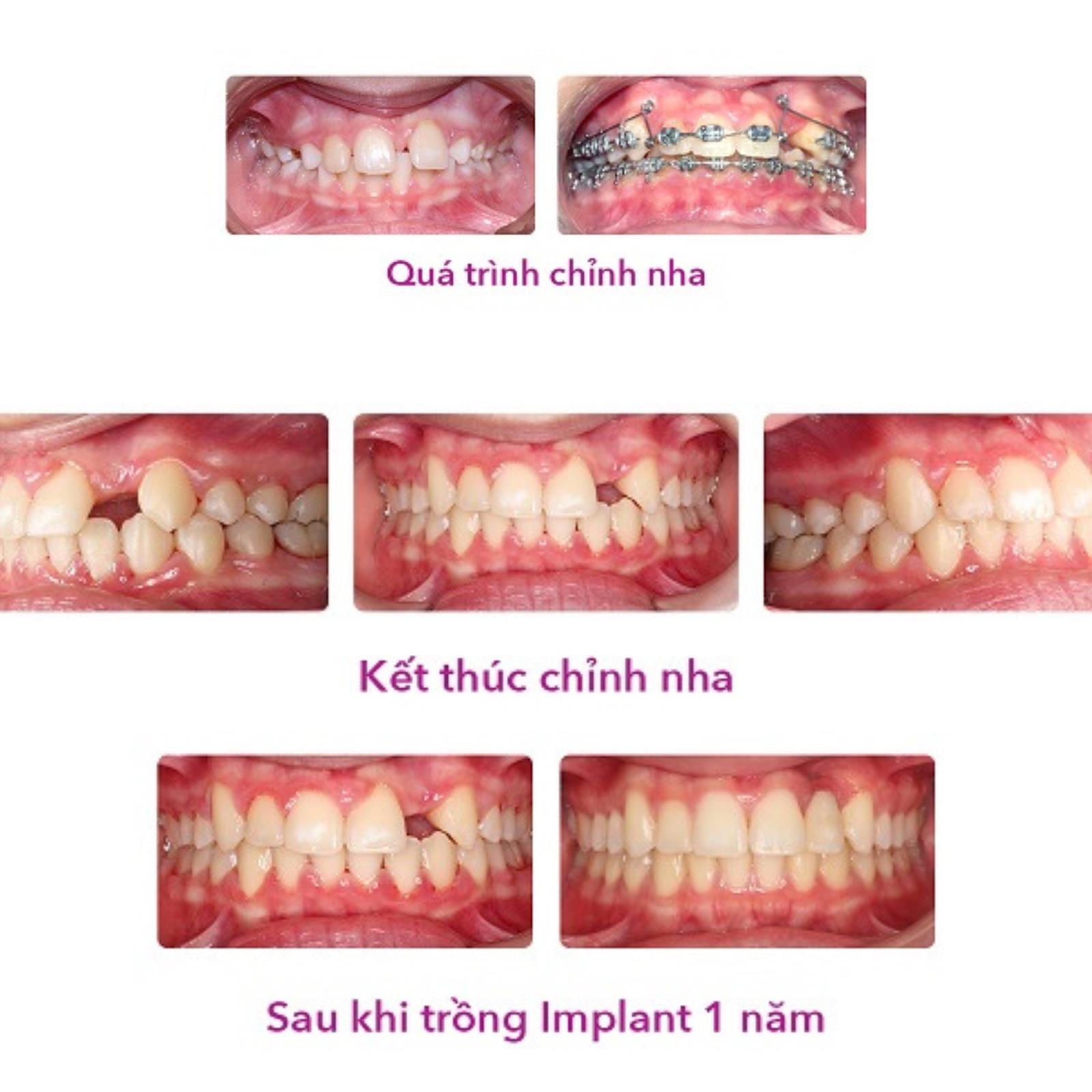 Khi nào cần làm thêm điều trị thẩm mỹ sau niềng răng?