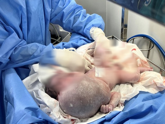 Bé trai sơ sinh có khối bướu khổng lồ - Ảnh 1.