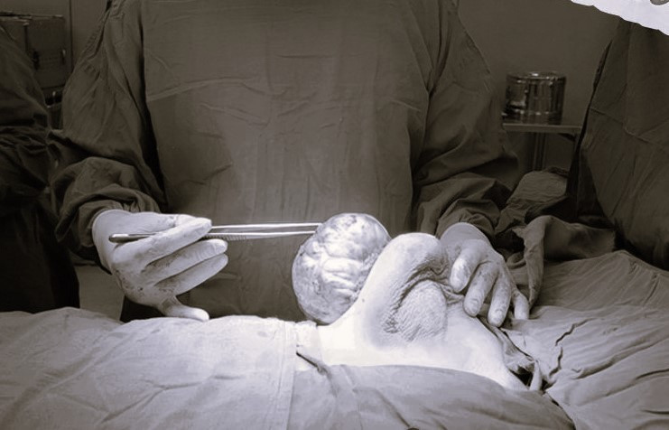 Khối u vú khổng lồ khiến thiếu nữ 15 tuổi khó khăn khi vận động