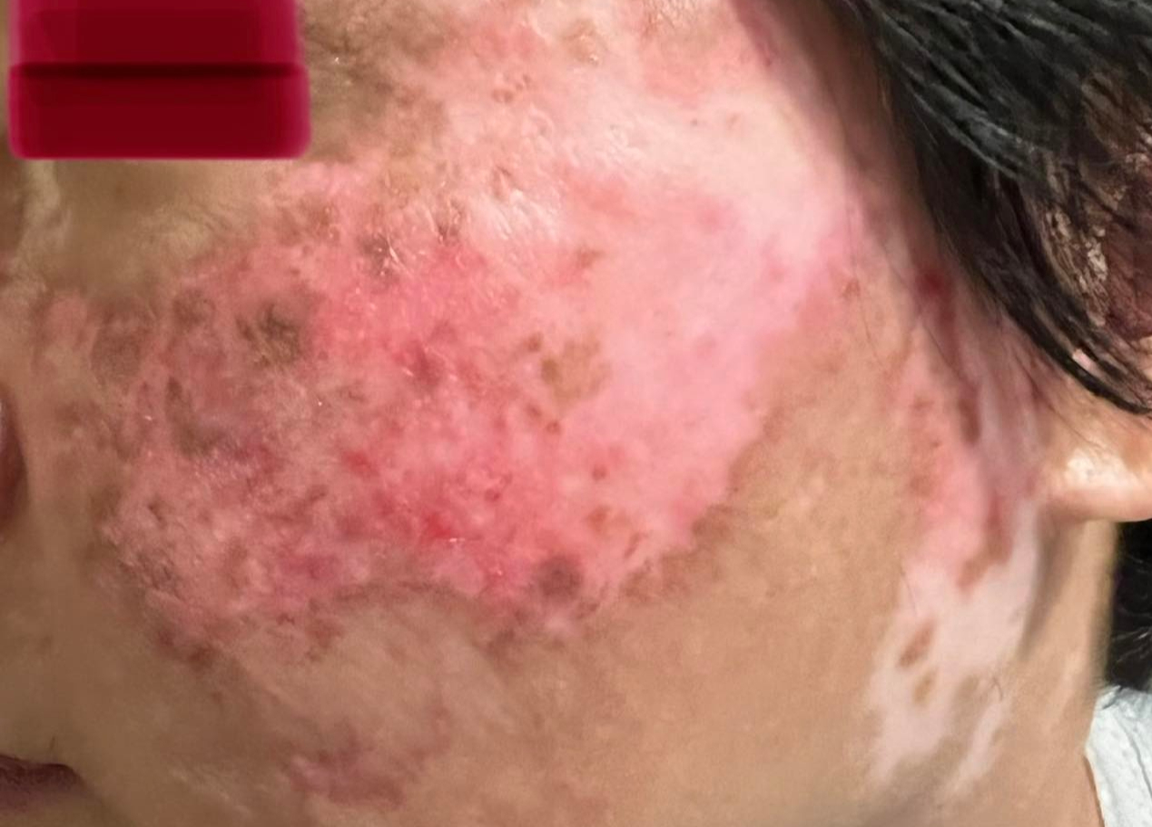 Dùng đơn thuốc cũ chữa lupus ban đỏ, nữ bệnh nhân trẻ phải lọc máu cấp cứu