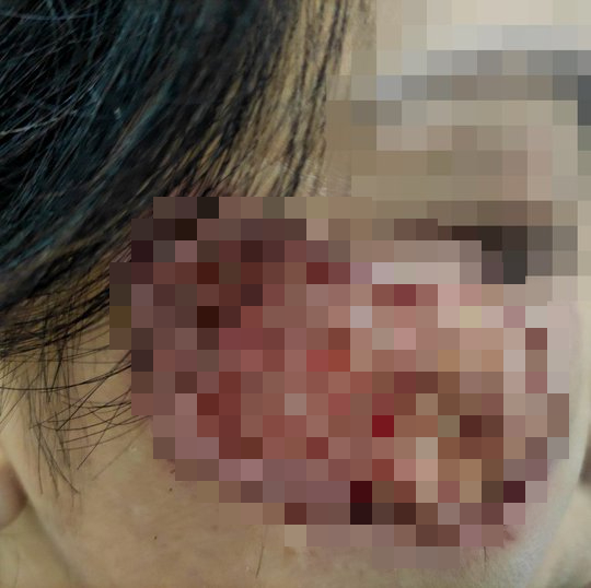 Mua "thuốc chứa axit" trị nám: Chưa đẹp đã loét mặt