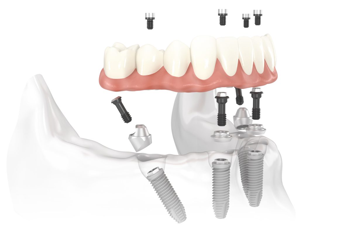 Trồng răng Implant phục hồi mất răng to&agrave;n h&agrave;m: tạm biệt h&agrave;m th&aacute;o lắp, sang trang cuộc đời - Ảnh 2.