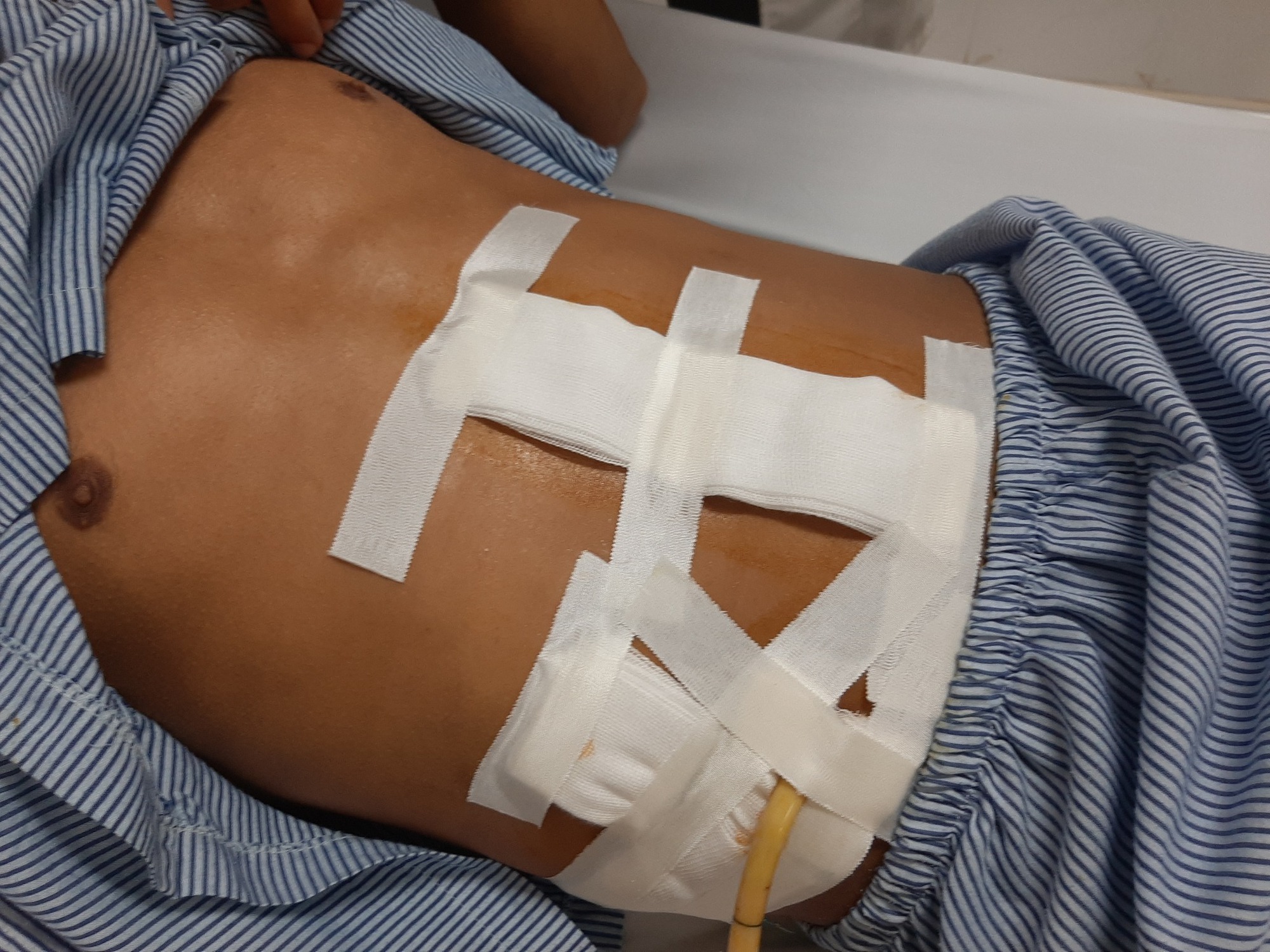Hai thanh ni&ecirc;n bị đ&acirc;m thủng ruột nguy kịch - Ảnh 1.