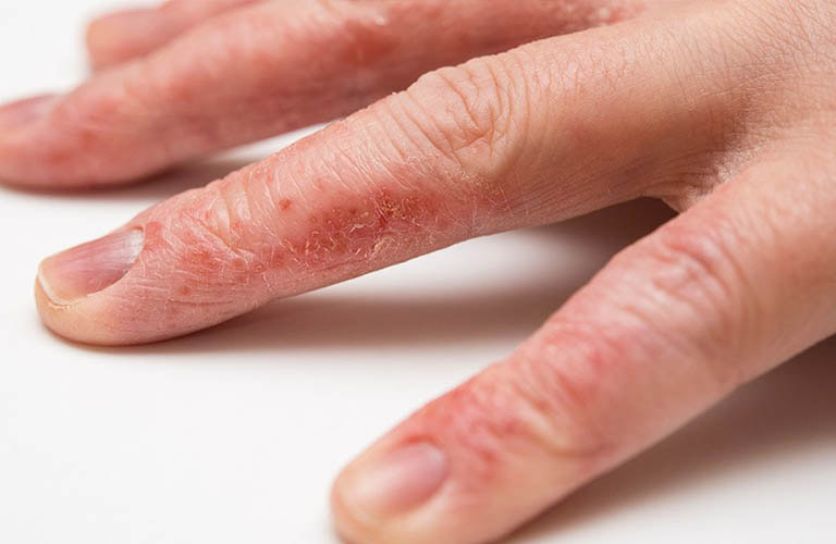 Làm sao cắt cơn ngứa của bệnh chàm?