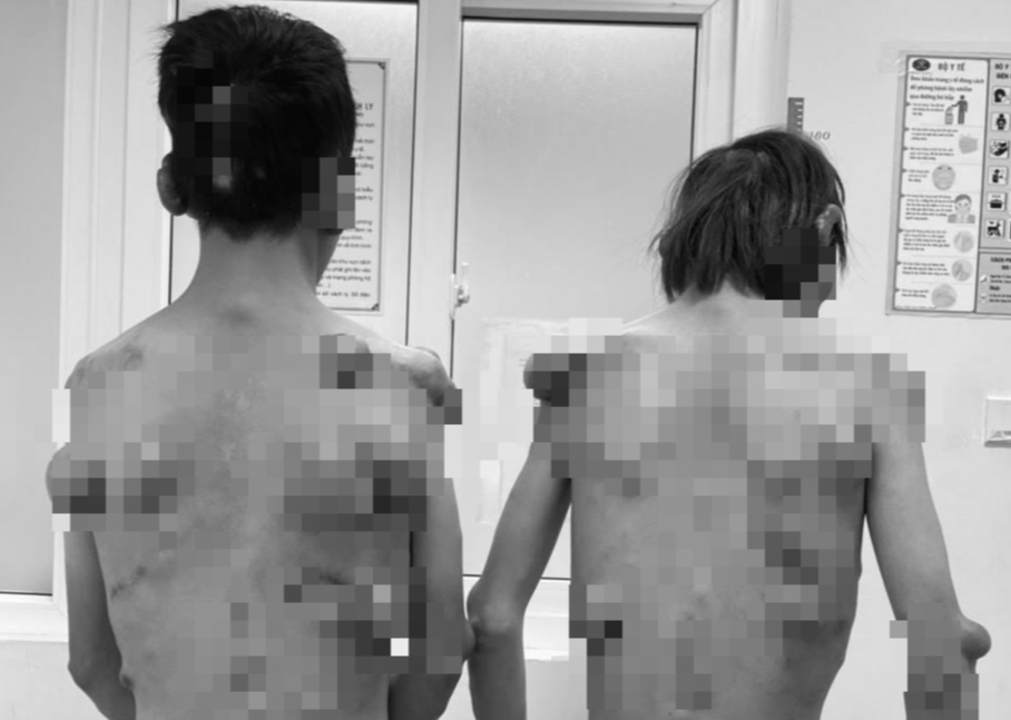 Căn bệnh khiến 2 anh em sinh đôi mọc hàng trăm khối u trên người