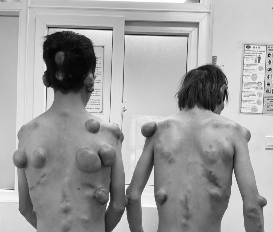 Căn bệnh khiến 2 anh em sinh đ&ocirc;i mọc h&agrave;ng trăm khối u tr&ecirc;n người - Ảnh 1.
