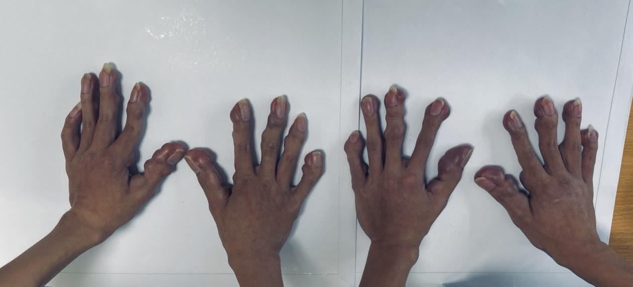 Căn bệnh khiến 2 anh em sinh đ&ocirc;i mọc h&agrave;ng trăm khối u tr&ecirc;n người - Ảnh 2.