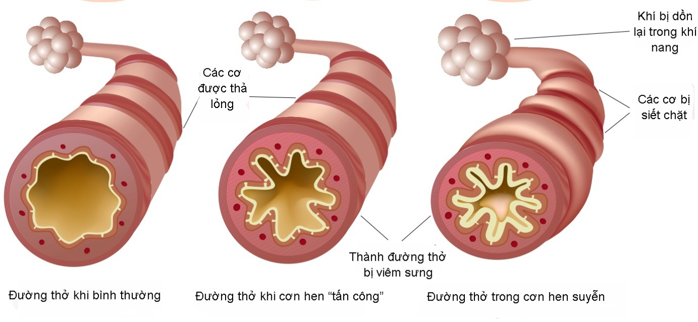 Giải pháp cải thiện ho, khò khè, khó thở - Ảnh 1.
