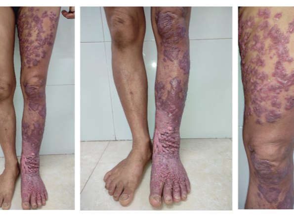 Nhiễm loại nấm da "bị lãng quên", chân người phụ nữ sần sùi như vỏ cây