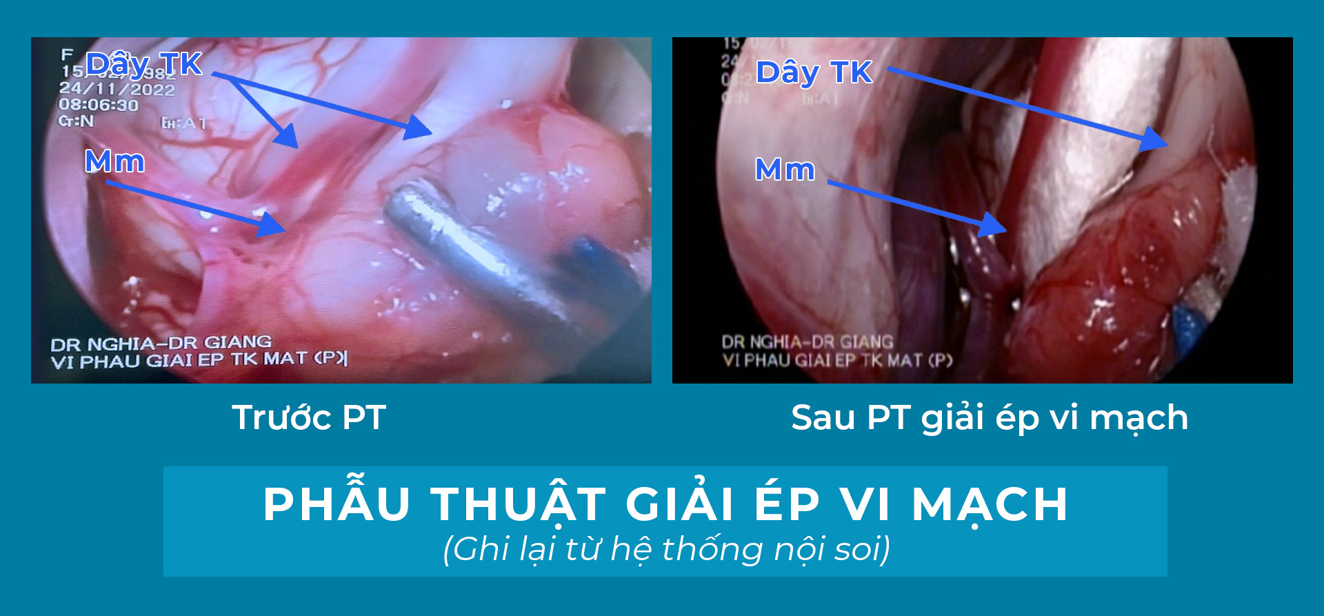 Người phụ nữ thoát cảnh sợ hãi mỗi khi lái xe vì co giật nửa mặt