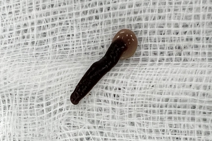 Gắp con đỉa trâu dài 5 cm kí sinh trong mũi người đàn ông - Ảnh 1.
