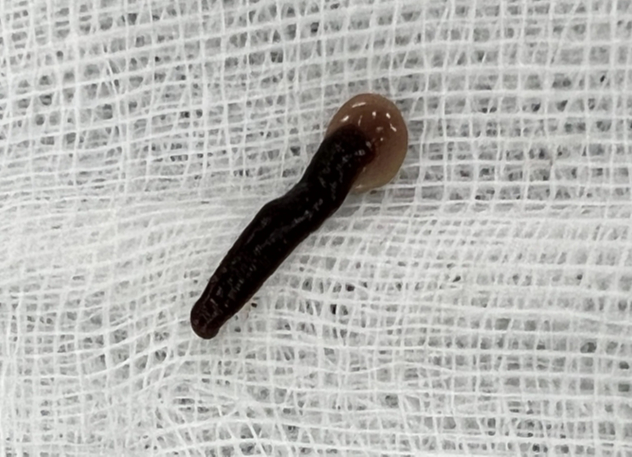Gắp con đỉa trâu dài 5 cm kí sinh trong mũi người đàn ông